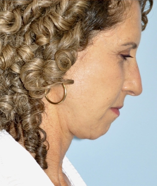 after neck lift side view female case 3890