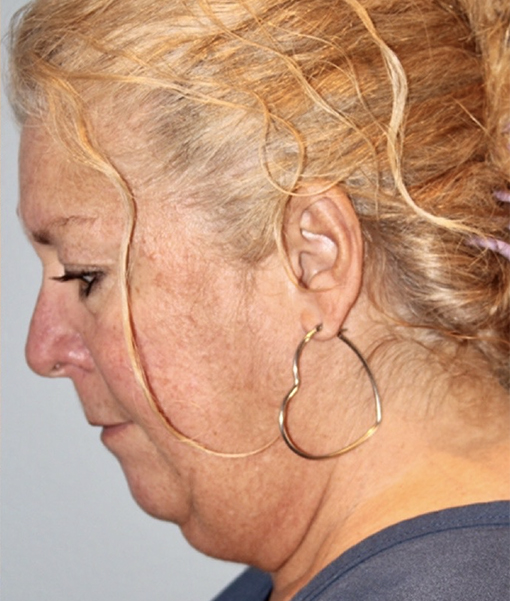before facelift side view female case 3911
