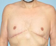 after gynecomastia front view case 3841