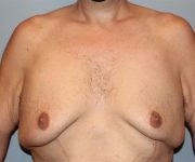 before gynecomastia front view case 3841
