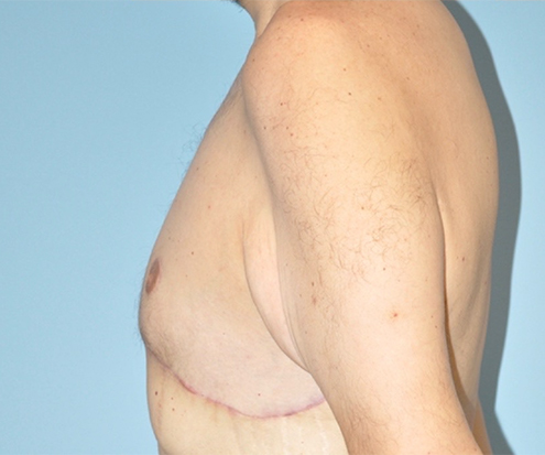 after gynecomastia side view case 3841