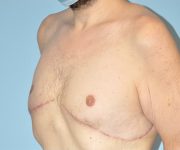 after gynecomastia left angle view case 3841