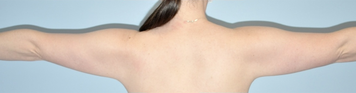 before liposuction female patient back angle view Case 3679