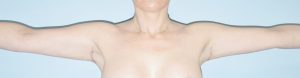 after liposuction female patient front angle view Case 3679