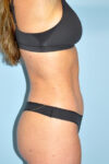 after liposuction female patient side angle view Case 3692