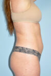 before liposuction female patient side angle view Case 3692