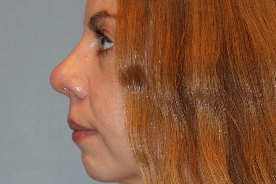 after rhinoplasty side view female patient case 3848