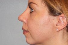 before rhinoplasty side view female patient case 3848