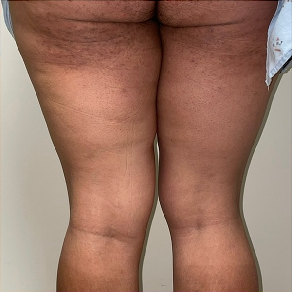 before Thigh Lift female patient back angle view Case 3443