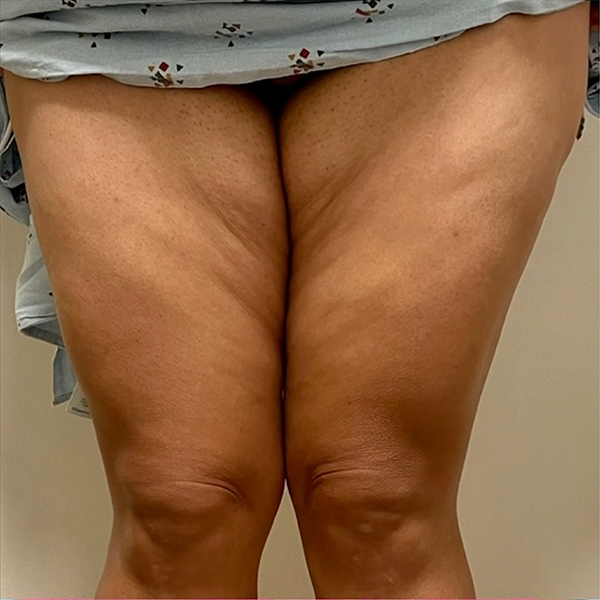 before Thigh Lift female patient front angle view Case 3443