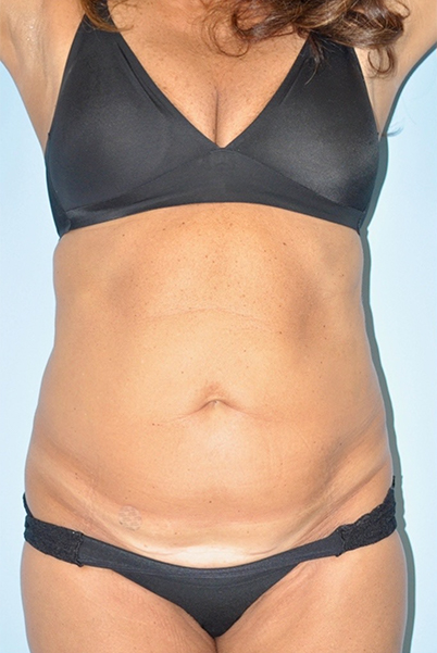 before tummy tuck front view female patient case 3946