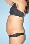 before tummy tuck side view female patient case 3946