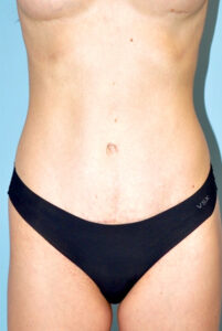 after tummy tuck front view female patient case 2730