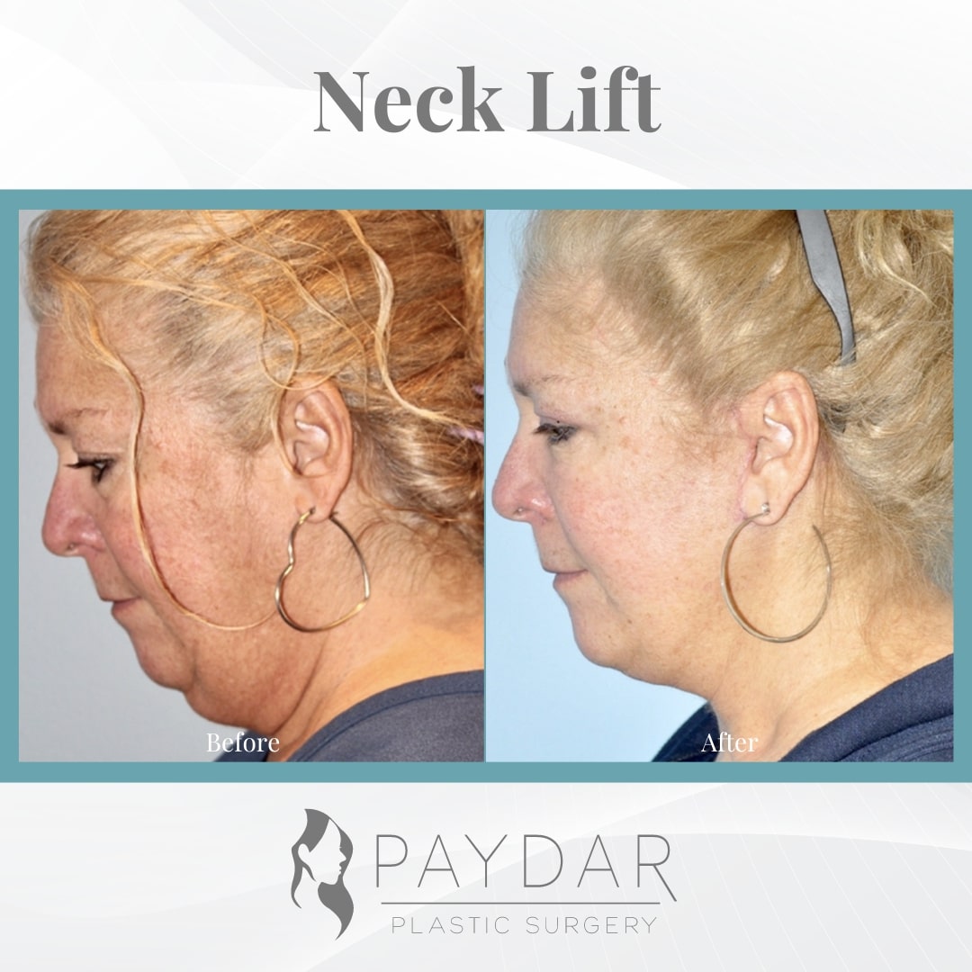 female neck lift before and after newport beach ca