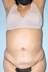 Patient Tummy Tuck Before 0