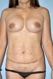 Patient Tummy Tuck Before 0