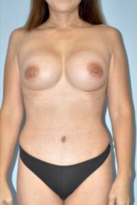 Patient Tummy Tuck After 0