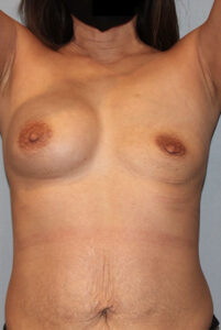 Patient Tummy Tuck Before 0