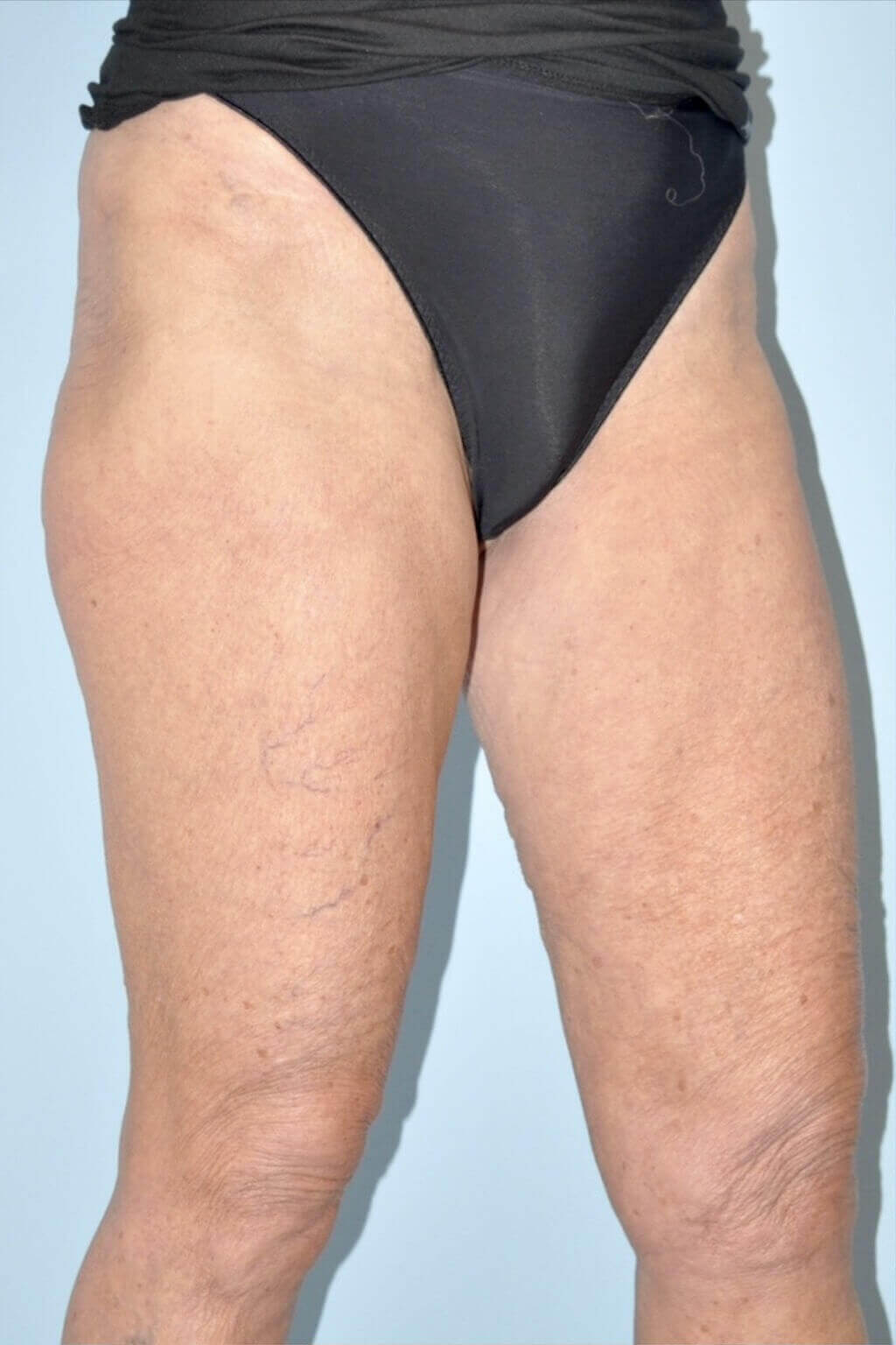 Patient Thigh Lift Before 1