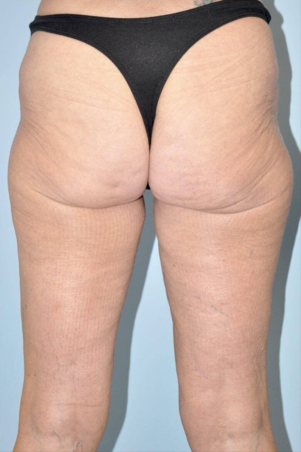 Patient Thigh Lift Before 2