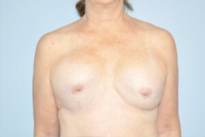 Patient Breast Implant Revision Before 0