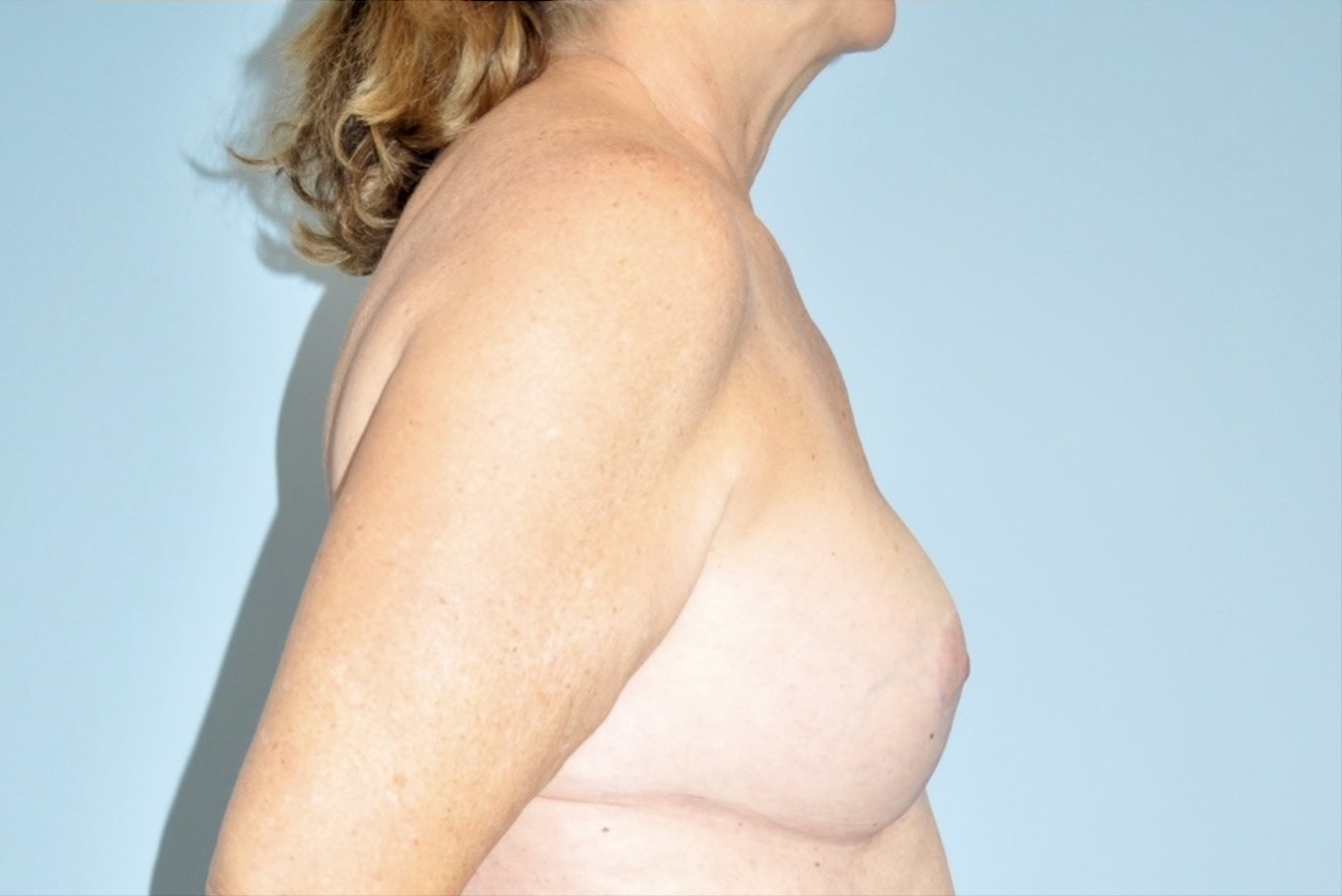Patient Breast Implant Revision Before 2