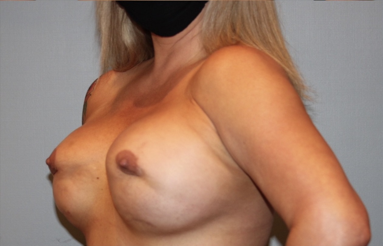 Patient Breast Implant Revision Before 1
