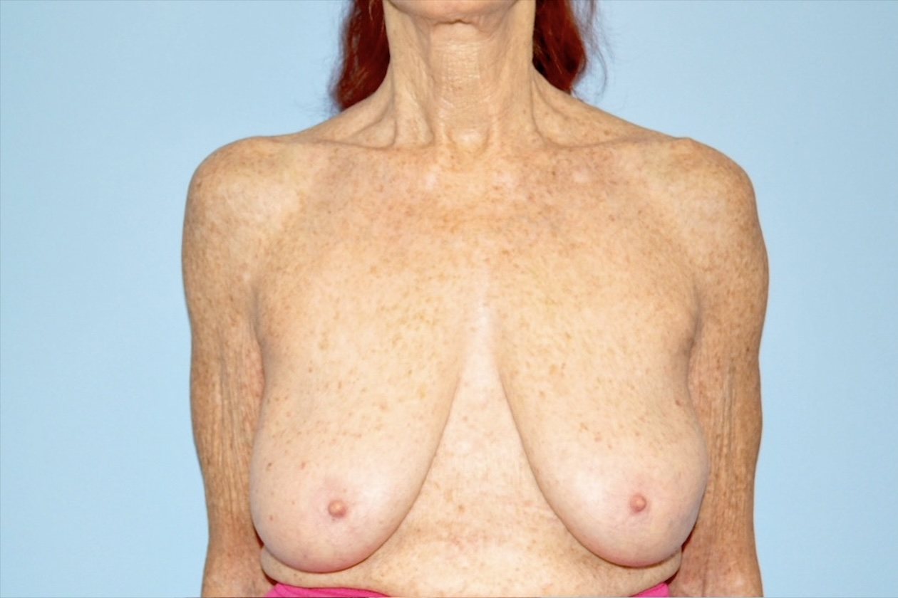 Patient Breast Lift Before 0