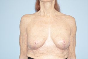 Patient Breast Lift After 0