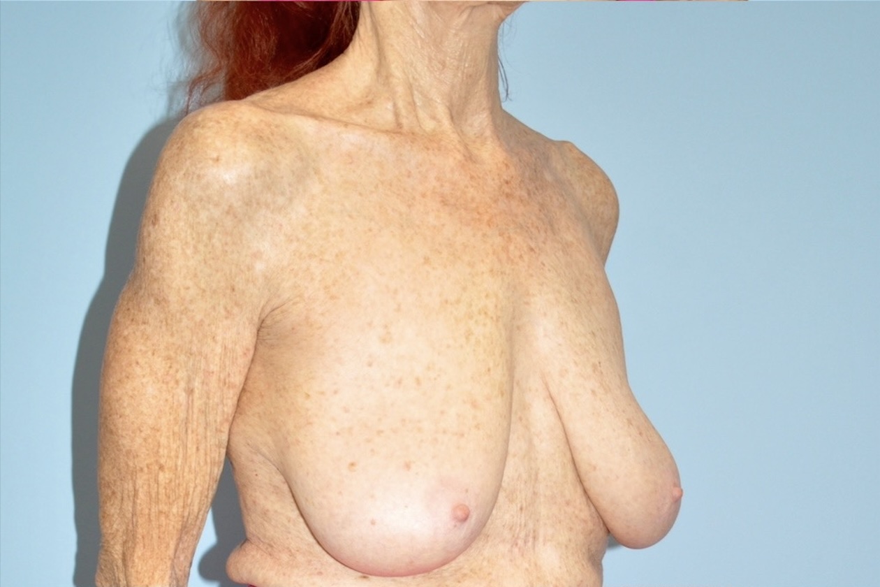 Patient Breast Lift Before 1