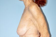 Patient Breast Reduction Thumbnail Before 2