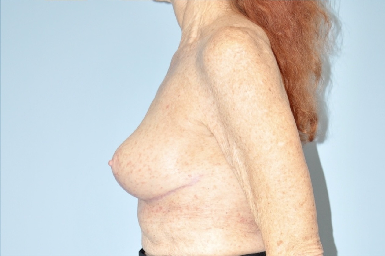 Patient Breast Reduction Before 2