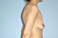 Patient Breast Augmentation Mastopexy Thumbnail Before 2