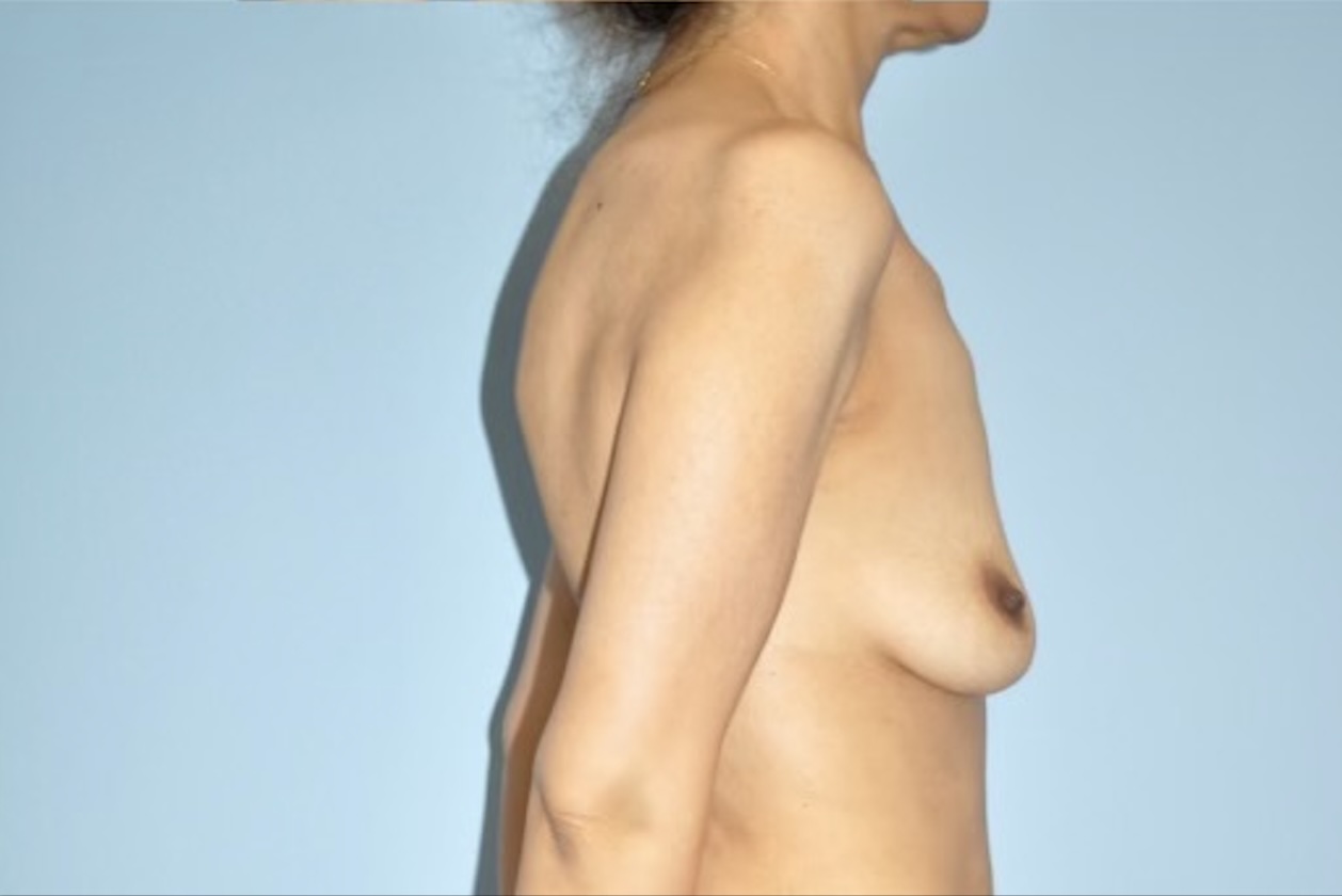 Patient Breast Lift Before 2