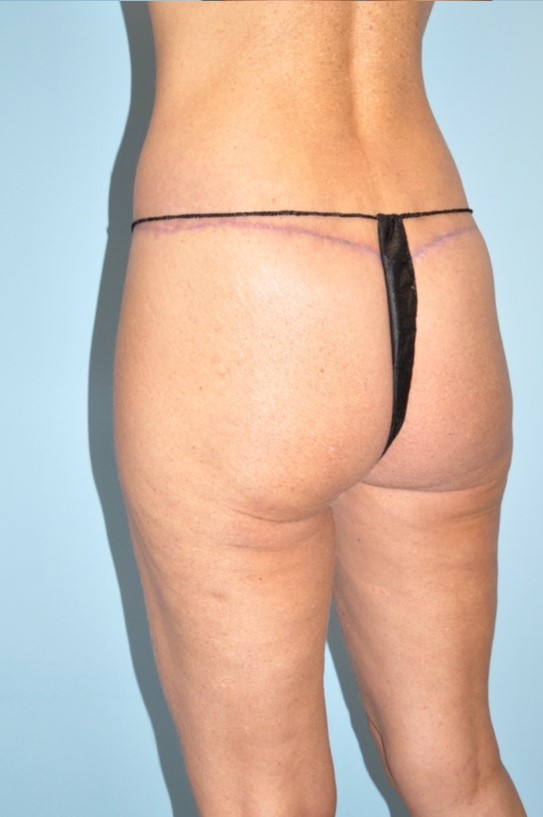 Patient Brazilian Butt Lift Before 1