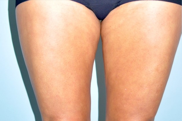 Patient Thigh Lift Before 0