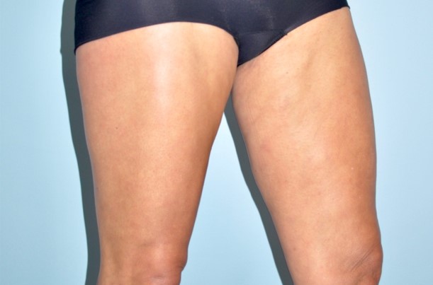 Patient Thigh Lift Before 1