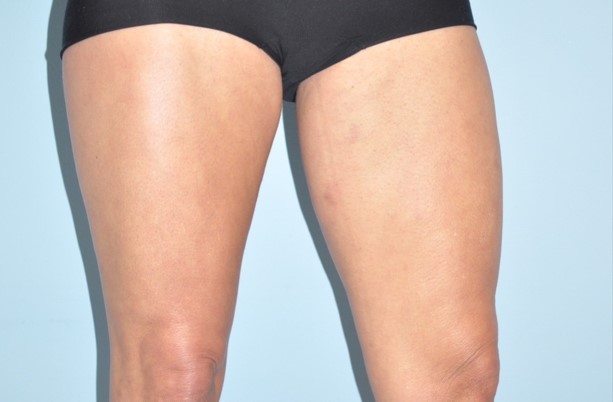 Patient Thigh Lift Before 1